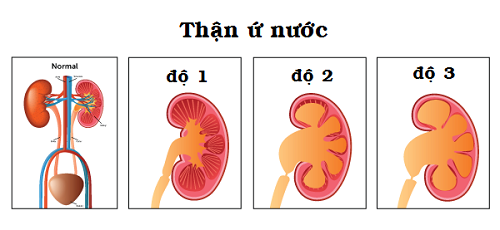 Thận ứ nước (tiếng Anh là Hydronephrosis) là 1 dạng tổn thương của thận biểu hiện ở việc thận bị giãn nở hoặc sưng to lên do nước tiểu bị ứ đọng, tắc nghẽn lại bên trong. Tình trạng này có thể xảy ra chỉ ở một bên thận hoặc ở cả hai bên, gây tổn thương cấu trúc tế bào và suy giảm chức năng thận.