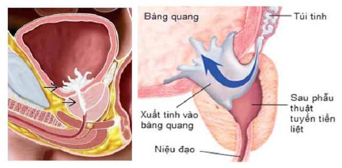 Xuất tinh ngược dòng